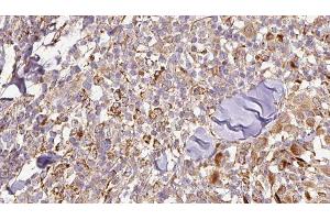 ABIN6276844 at 1/100 staining Human Melanoma tissue by IHC-P. (SCGB1A1 anticorps  (Internal Region))