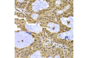 Immunohistochemistry of paraffin-embedded human oophoroma using XPO5 antibody at dilution of 1:100 (x400 lens). (XPO5 anticorps)