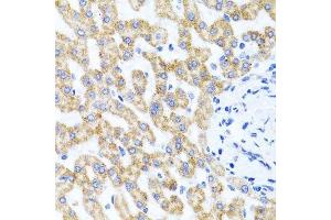 Immunohistochemistry of paraffin-embedded human liver injury using RIPK4 antibody. (RIPK4 anticorps  (AA 240-520))