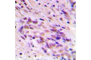 Immunohistochemical analysis of CDYL2 staining in human breast cancer formalin fixed paraffin embedded tissue section.