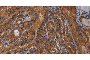 Immunohistochemistry of paraffin-embedded Human thyroid cancer tissue using MAGEB10 Polyclonal Antibody at dilution 1:60 (MAGEB10 anticorps)