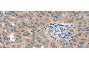Immunohistochemistry of paraffin-embedded Human ovarian cancer tissue using P2RY6 Polyclonal Antibody at dilution of 1:40(x200) (P2RY6 anticorps)