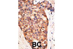 Formalin-fixed and paraffin-embedded human cancer tissue reacted with XIAP polyclonal antibody  , which was peroxidase-conjugated to the secondary antibody, followed by AEC staining. (XIAP anticorps  (N-Term))