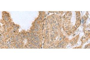 Immunohistochemistry of paraffin-embedded Human thyroid cancer tissue using CSRP2 Polyclonal Antibody at dilution of 1:60(x200) (CSRP2 anticorps)