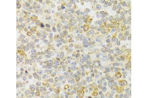 Immunohistochemistry of paraffin-embedded Human B cell lymphoma using KISS1R Polyclonal Antibody at dilution of 1:100 (40x lens). (KISS1R anticorps)