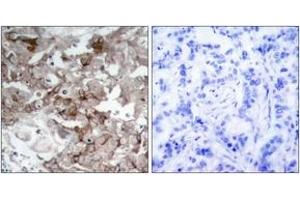 Immunohistochemistry analysis of paraffin-embedded human breast carcinoma tissue, using Cortactin (Ab-466) Antibody. (Cortactin anticorps  (AA 441-490))