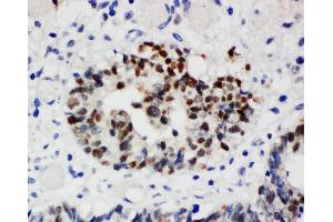 Anti-Nucleophosmin antibody, IHC(P) IHC(P): Human Intestinal Cancer Tissue (NPM1 anticorps  (N-Term))
