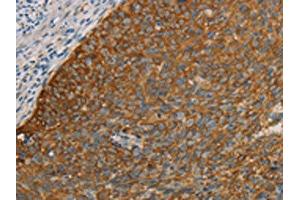 The image on the left is immunohistochemistry of paraffin-embedded Human cervical cancer tissue using ABIN7190690(FOXF2 Antibody) at dilution 1/30, on the right is treated with synthetic peptide. (FOXF2 anticorps)