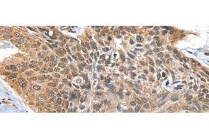 Immunohistochemistry of paraffin-embedded Human esophagus cancer tissue using BOLA1 Polyclonal Antibody at dilution of 1:35(x200) (BOLA1 anticorps)