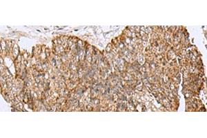 Immunohistochemistry of paraffin-embedded Human colorectal cancer tissue using HCCS Polyclonal Antibody at dilution of 1:110(x200) (HCCS anticorps)