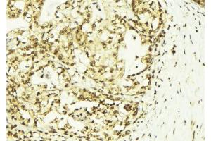 ABIN6273143 at 1/100 staining Human breast cancer tissue by IHC-P. (SSNA1 anticorps  (N-Term))