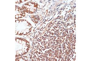 Immunohistochemistry of paraffin-embedded human colon using Phospho-VASP-S157 antibody (ABIN6135335, ABIN6136286, ABIN6136287 and ABIN6225657) at dilution of 1:100 (40x lens). (VASP anticorps  (pSer157))