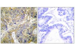 Immunohistochemistry analysis of paraffin-embedded human colon carcinoma tissue, using ES8L3 antibody. (EPS8-Like 3 anticorps  (Internal Region))