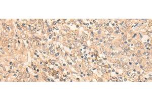 Immunohistochemistry of paraffin-embedded Human cervical cancer tissue using EIF2B5 Polyclonal Antibody at dilution of 1:25(x200) (EIF2B5 anticorps)