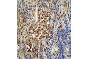 Formalin fixed, paraffin embedded human lung carcinoma stained with PUS3 Antibody (N-term) followed by peroxidase conjugation of the secondary antibody and DAB staining.