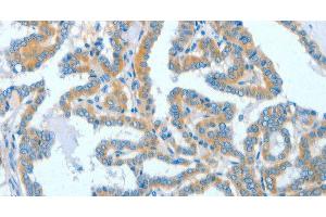 Immunohistochemistry of paraffin-embedded Human thyroid cancer tissue using ASCC1 Polyclonal Antibody at dilution 1:50
