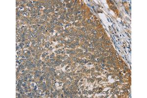 Immunohistochemistry of Human thyroid cancer using TNFRSF10D Polyclonal Antibody at dilution of 1:40 (DcR2 anticorps)