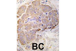Formalin-fixed and paraffin-embedded human breast carcinoma tissue reacted with HSPB1 polyclonal antibody  , which was peroxidase-conjugated to the secondary antibody, followed by DAB staining. (HSP27 anticorps  (Ser82))