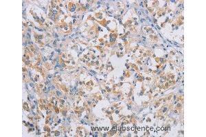 Immunohistochemistry of Human gastric cancer using CERKL Polyclonal Antibody at dilution of 1:50 (CERKL anticorps)