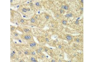 Immunohistochemistry of paraffin-embedded Human liver damage using DLD Polyclonal Antibody at dilution of 1:100 (40x lens). (DLD anticorps)