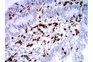 Immunohistochemical analysis of paraffin-embedded rectum cancer tissues using CD2 mouse mAb with DAB staining. (CD2 anticorps  (AA 25-140))