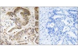 Immunohistochemistry analysis of paraffin-embedded human colon carcinoma tissue, using PIK3R5 Antibody. (PIK3R5 anticorps  (AA 695-744))