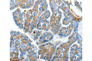 Immunohistochemistry of Human esophagus cancer using CLPTM1L Polyclonal Antibody at dilution of 1:60 (CLPTM1L anticorps)