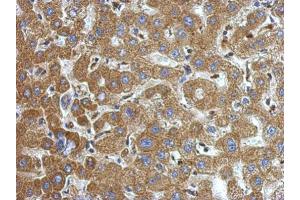 IHC-P Image Immunohistochemical analysis of paraffin-embedded human hepatoma, using alpha-1-Microglobulin, antibody at 1:500 dilution.