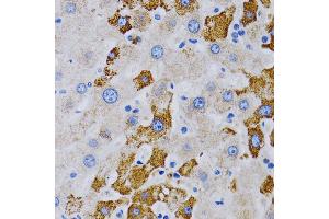 Immunohistochemistry of paraffin-embedded human liver cancer using CYP24 antibody (805) at dilution of 1:200 (40x lens). (CYP24A1 anticorps  (AA 36-448))