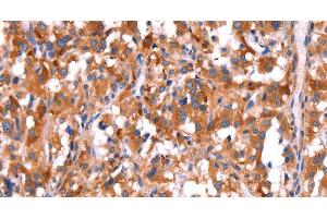 Immunohistochemistry of paraffin-embedded Human thyroid cancer tissue using GCG Polyclonal Antibody at dilution 1:40