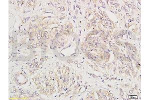 Formalin-fixed and human breast carcinoma tissue labeled with Anti-KLK1 Polyclonal Antibody (ABIN675983), Unconjugated at 1:200 followed by conjugation to the secondary antibody and DAB staining (Kallikrein 1 anticorps  (AA 101-200))