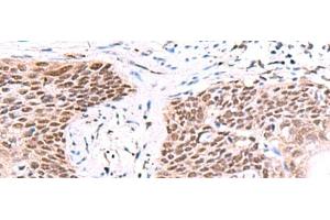 Immunohistochemistry of paraffin-embedded Human esophagus cancer tissue using IRF2BP1 Polyclonal Antibody at dilution of 1:40(x200) (IRF2BP1 anticorps)