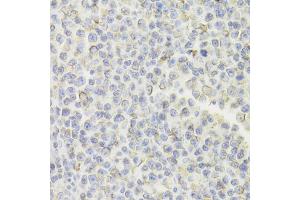 Immunohistochemistry of paraffin-embedded human B cell lymphoma using CD74 Antibody (ABIN5973310) at dilution of 1/100 (40x lens). (CD74 anticorps)