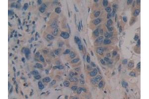 Detection of CD109 in Human Breast cancer Tissue using Polyclonal Antibody to Cluster Of Differentiation 109 (CD109) (CD109 anticorps  (AA 1146-1390))