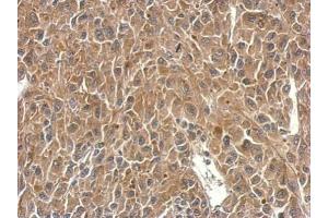 IHC-P Image SH3BP1 antibody detects SH3BP1 protein at cytosol on U87 xenograft by immunohistochemical analysis.