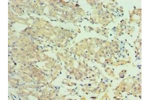Immunohistochemistry of paraffin-embedded human colon cancer using ABIN7160651 at dilution of 1:100 (MTMR4 anticorps  (AA 570-820))