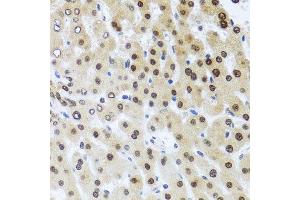Immunohistochemistry of paraffin-embedded human liver injury using RAD23B antibody.