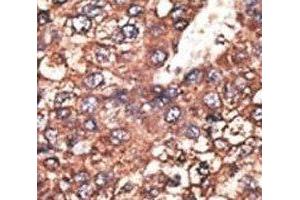 IHC analysis of FFPE human hepatocarcinoma tissue stained with the Leptin Receptor antibody