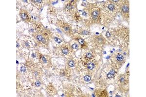 Immunohistochemistry of paraffin-embedded Human liver damage using AMY2A Polyclonal Antibody at dilution of 1:100 (40x lens).