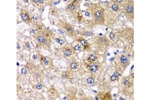 Immunohistochemistry of paraffin-embedded Human liver damage using AMY2A Polyclonal Antibody at dilution of 1:100 (40x lens). (AMY2A anticorps)