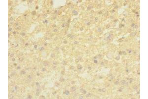 Immunohistochemistry of paraffin-embedded human glioma using ABIN7173241 at dilution of 1:100 (TMEM56 anticorps  (AA 232-263))