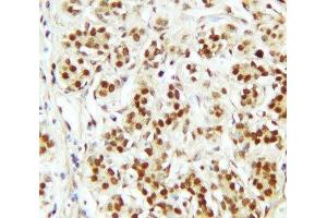 IHC-P: CTBP2 antibody testing of human breast cancer tissue (CTBP2 anticorps  (C-Term))