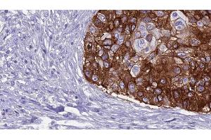 ABIN6269007 at 1/100 staining Human urothelial cancer tissue by IHC-P. (GRM8 anticorps  (C-Term))