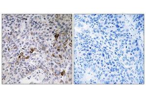 Immunohistochemistry analysis of paraffin-embedded human lung carcinoma tissue using RAB11FIP3 antibody. (RAB11FIP3 anticorps  (C-Term))