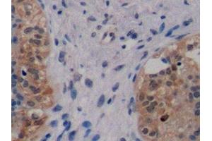 Detection of ErbB2 in Human Breast cancer Tissue using Monoclonal Antibody to Receptor Tyrosine Protein Kinase erbB-2 (ErbB2) (ErbB2/Her2 anticorps  (AA 376-578))