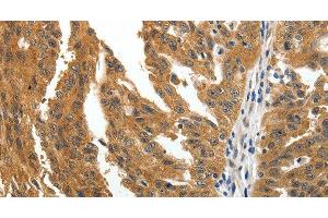Immunohistochemistry of paraffin-embedded Human ovarian cancer tissue using BIRC6 Polyclonal Antibody at dilution 1:30 (BIRC6 anticorps)