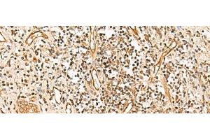 Immunohistochemistry of paraffin-embedded Human prost ate cancer tissue using HUS1 Polyclonal Antibody at dilution of 1:65(x200) (HUS1 anticorps)