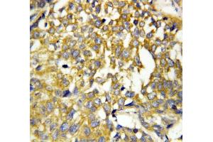 Anti-Pleiotrophin antibody, IHC(P) IHC(P): Human Mammary Cancer Tissue (Pleiotrophin anticorps  (C-Term))
