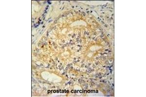 C antibody (N-term) (ABIN654965 and ABIN2844604) immunohistochemistry analysis in formalin fixed and paraffin embedded human prostate carcinoma followed by peroxidase conjugation of the secondary antibody and DAB staining.