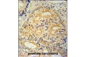C antibody (N-term) (ABIN654965 and ABIN2844604) immunohistochemistry analysis in formalin fixed and paraffin embedded human prostate carcinoma followed by peroxidase conjugation of the secondary antibody and DAB staining. (C16ORF13 anticorps  (N-Term))